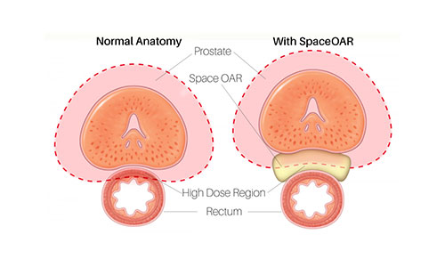 Mater-Private-SpaceOAR-hydrogel_illustration